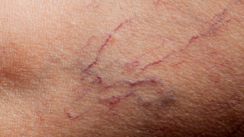 Spider veins treatment