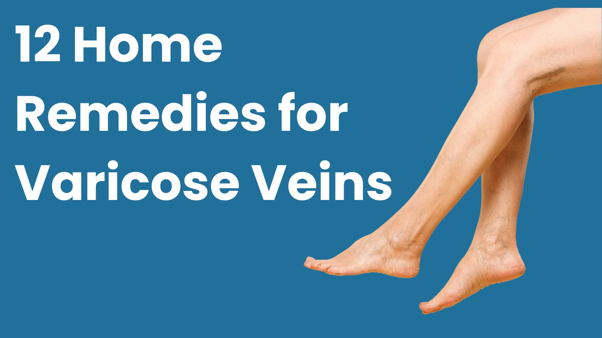 Varices