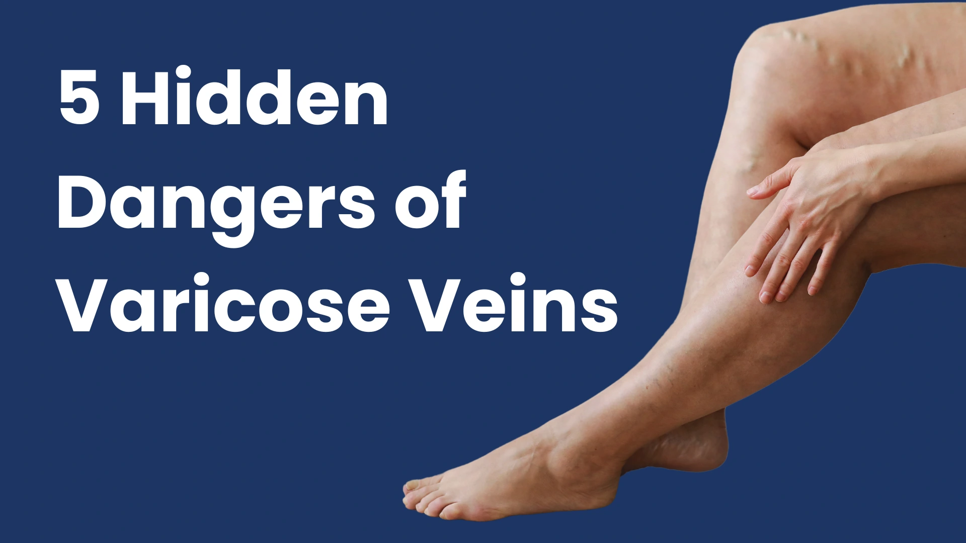 Varicose veins
