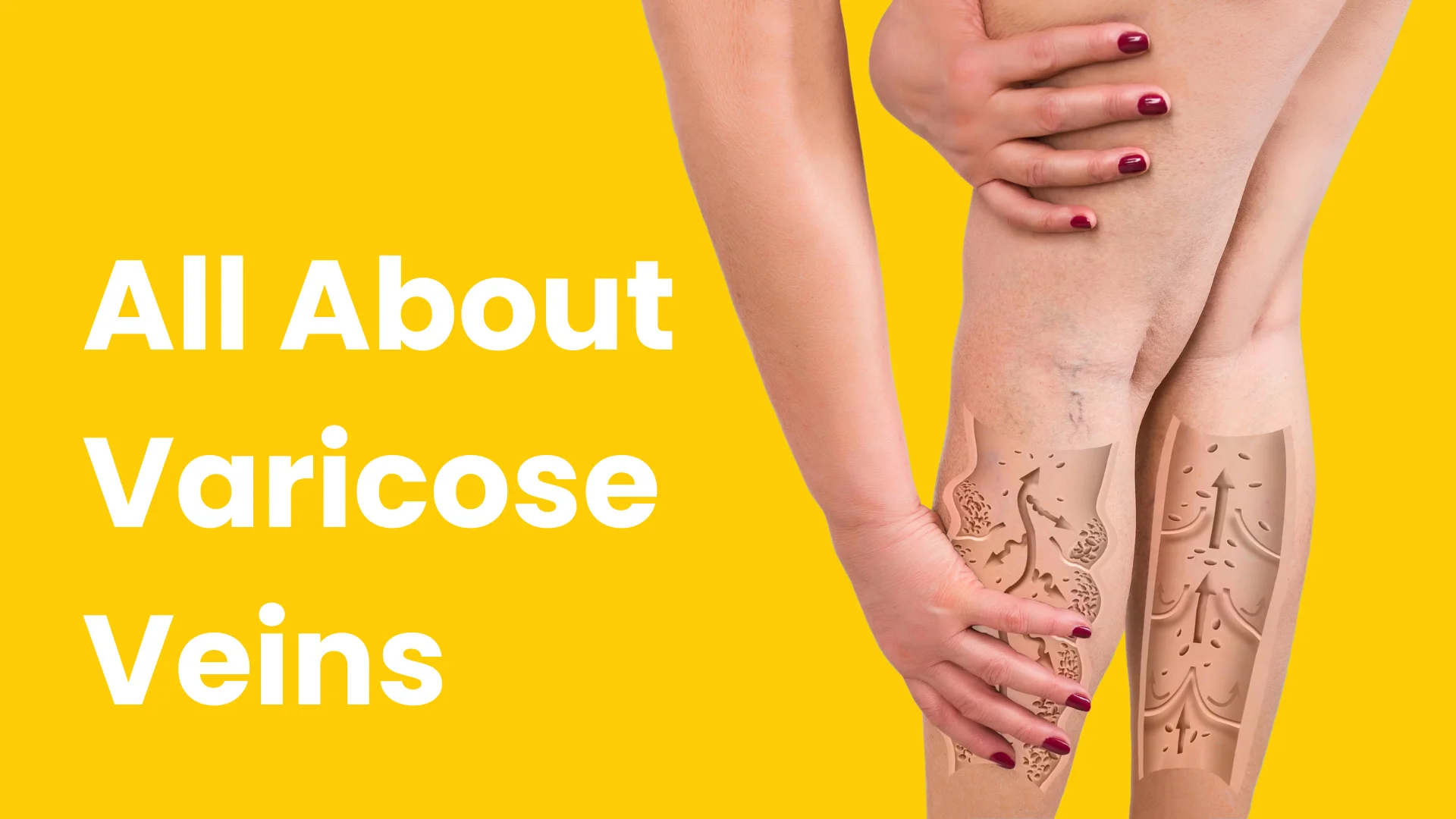 Varicose veins
