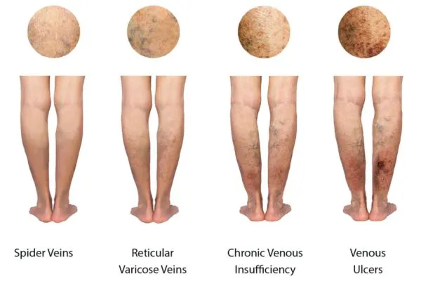 Tratamiento de las varices