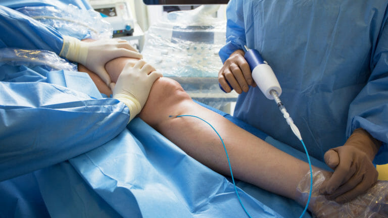 Varicose Vein treatment