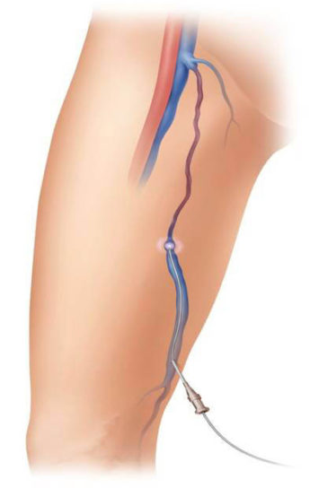 endovenous laser therapy foe varicose veins