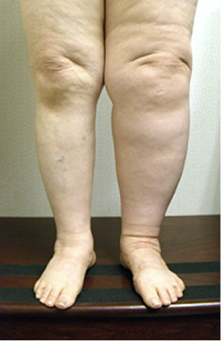 Lymphedema