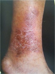 Venous Stasis Dermatitis