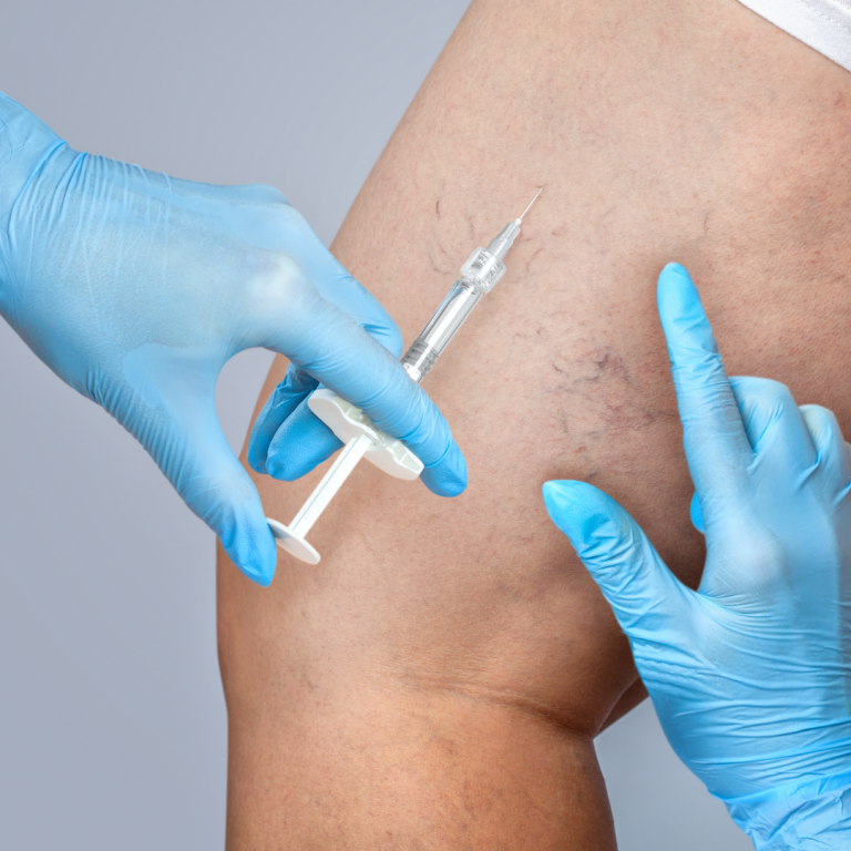 Compounded Sclerotherapy vein treatment
