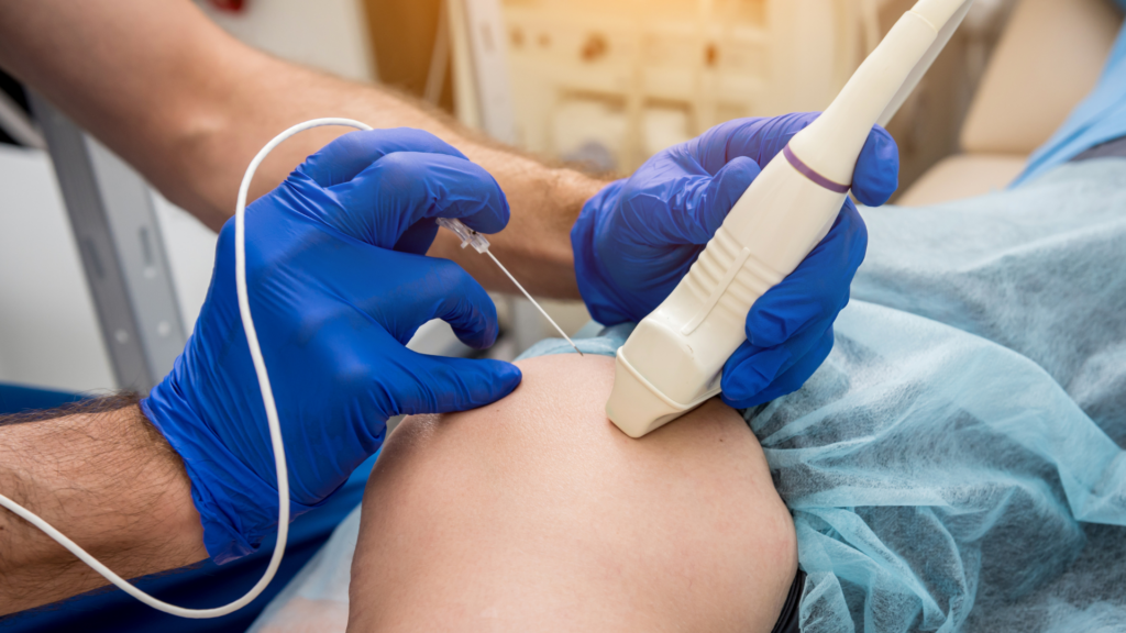 Varithena Albation vein treatment