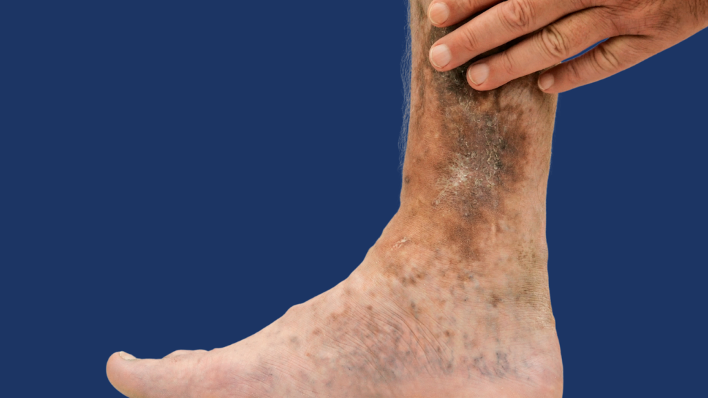 Varithena Albation vein treatment